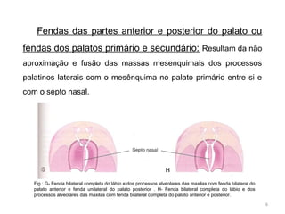 Fenda palatina, ll e fistula traqueoesofagica | PPT