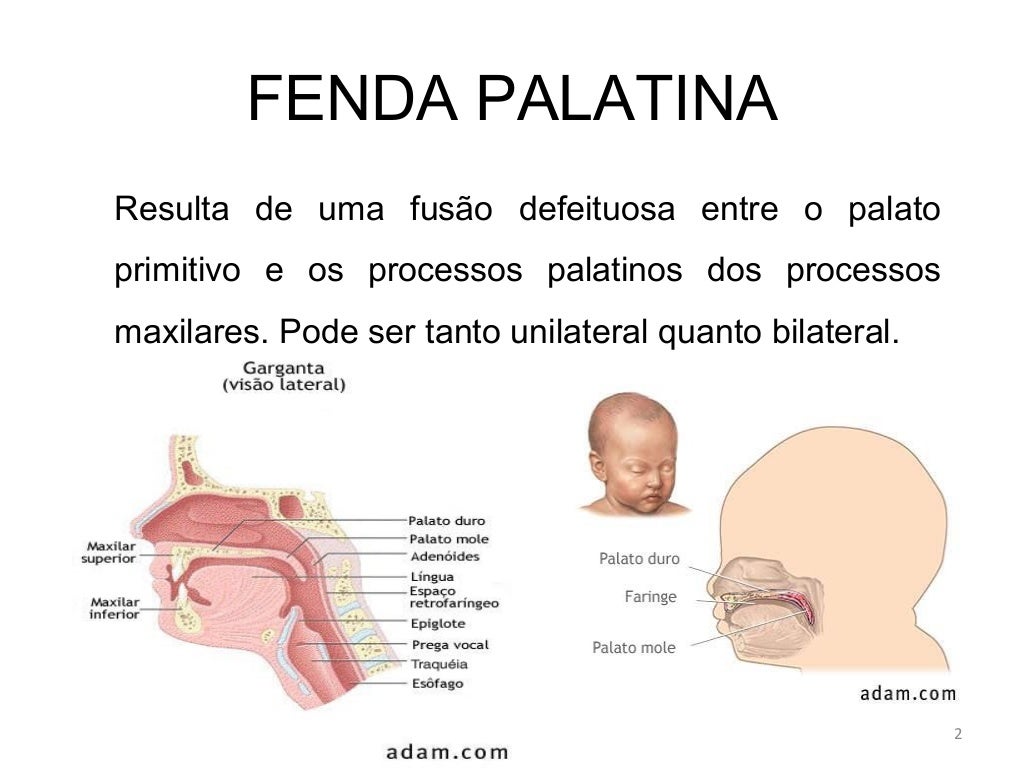 Tipos De Fendas Palatinas - RETOEDU