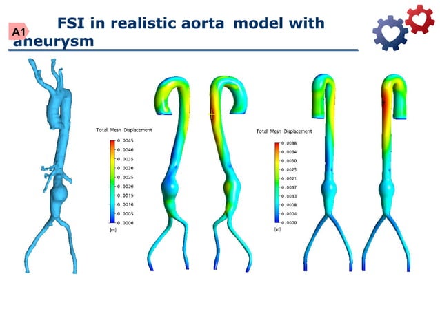 Fluid structure interaction in abdominal aortic aneurysm using ANSYS ...