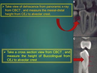  Take view of dehiscence from panoramic x-ray
from CBCT , and measure the mesial-distal
height from CEJ to alveolar crest.
 Take a cross section view from CBCT , and
measure the height of Buccolingual from
CEJ to alveolar crest
 