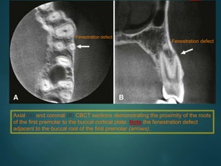 Axial (A) and coronal (B) CBCT sections demonstrating the proximity of the roots
of the first premolar to the buccal cortical plate. Note the fenestration defect
adjacent to the buccal root of the first premolar (arrows).
Fenestration defect
Fenestration defect
 