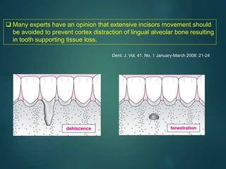  Many experts have an opinion that extensive incisors movement should
be avoided to prevent cortex distraction of lingual alveolar bone resulting
in tooth supporting tissue loss.
Dent. J. Vol. 41. No. 1 January-March 2008: 21-24
 