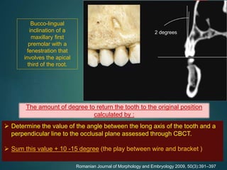 Bucco-lingual
inclination of a
maxillary first
premolar with a
fenestration that
involves the apical
third of the root.
Romanian Journal of Morphology and Embryology 2009, 50(3):391–397
The amount of degree to return the tooth to the original position
calculated by :
 Determine the value of the angle between the long axis of the tooth and a
perpendicular line to the occlusal plane assessed through CBCT.
 Sum this value + 10 -15 degree (the play between wire and bracket )
 