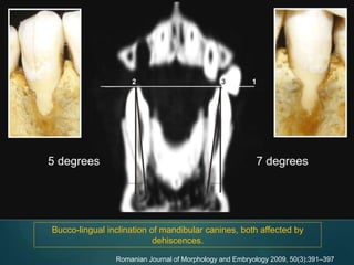 Bucco-lingual inclination of mandibular canines, both affected by
dehiscences.
Romanian Journal of Morphology and Embryology 2009, 50(3):391–397
 