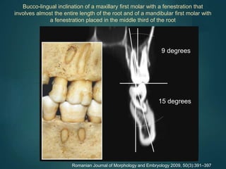 Romanian Journal of Morphology and Embryology 2009, 50(3):391–397
Bucco-lingual inclination of a maxillary first molar with a fenestration that
involves almost the entire length of the root and of a mandibular first molar with
a fenestration placed in the middle third of the root
 