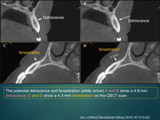 The potential dehiscence and fenestration (white arrow) A and B show a 4.8-mm
dehiscence; C and D show a 4.3-mm fenestration on the CBCT scan
Am J Orthod Dentofacial Orthop 2015;147:313-23)
Dehiscence
Dehiscence
fenestration
fenestration
 