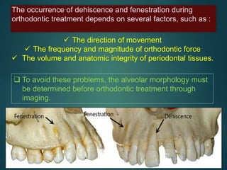 Fenestration and dehiscence