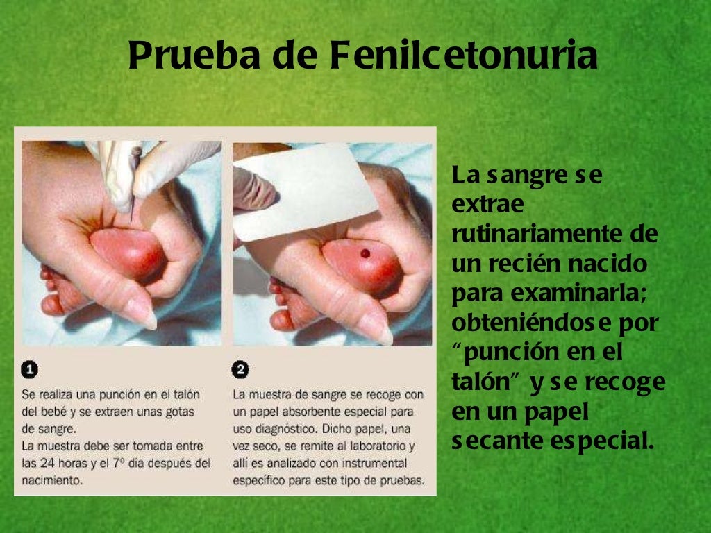 Fenilcetonuria