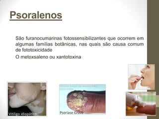 Psoralenos

    São furanocumarinas fotossensibilizantes que ocorrem em
    algumas famílias botânicas, nas quais são causa comum
    de fototoxicidade
    O metoxsaleno ou xantotoxina




Vitiligo idiopático    Psoríase Grave
 