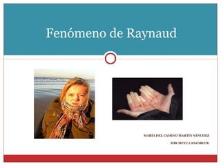 Fenómeno de Raynaud




              MARÍA DEL CAMINO MARTÍN SÁNCHEZ

                          MIR MFYC LANZAROTE
 