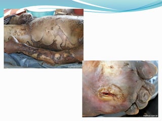 FENÔMENOS CADAVÉRICOS  E SUAS TRANSFORMAÇÕES