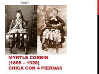 MYRTLE CORBIN
(1868 – 1928)
CHICA CON 4 PIERNAS
dipygus
 
