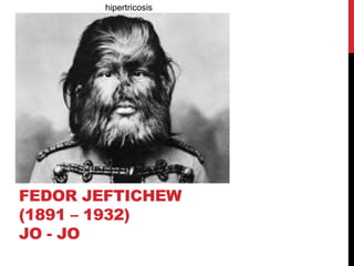 FEDOR JEFTICHEW
(1891 – 1932)
JO - JO
hipertricosis
 
