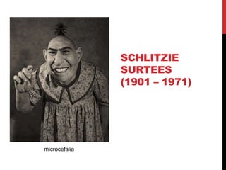 SCHLITZIE
SURTEES
(1901 – 1971)
microcefalia
 