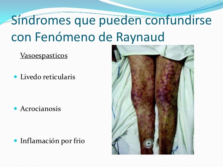 Fenomeno de Raynaud