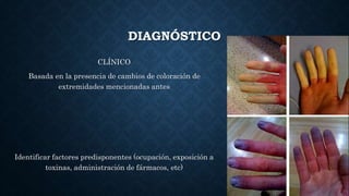 DIAGNÓSTICO
CLÍNICO
Basada en la presencia de cambios de coloración de
extremidades mencionadas antes
Identificar factores predisponentes (ocupación, exposición a
toxinas, administración de fármacos, etc)
 