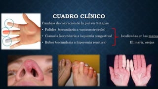 CUADRO CLÍNICO
Cambios de coloración de la piel en 3 etapas
• Palidez (secundaria a vasoconstricción)
• Cianosis (secundaria a isquemia congestiva) localizadas en las manos
• Rubor (secundaria a hiperemia reactiva) EI, nariz, orejas
 