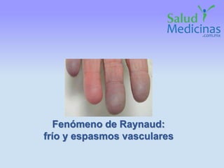 Fenómeno de Raynaud:
frío y espasmos vasculares
 