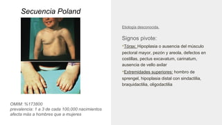 Secuencia Poland
OMIM: %173800
prevalencia: 1 a 3 de cada 100,000 nacimientos
afecta más a hombres que a mujeres
Etiología desconocida.
Signos pivote:
•Tórax: Hipoplasia o ausencia del músculo
pectoral mayor, pezón y areola, defectos en
costillas, pectus excavatum, carinatum,
ausencia de vello axilar
•Extremidades superiores: hombro de
sprengel, hipoplasia distal con sindactilia,
braquidactilia, oligodactilia
 