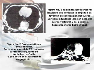Figura No. 1 Tac: masa gavabertebral  izquierda que aumenta la amplitud del  fovamen de conjugación del cuerpo  vertebral adyacente ,erosión osea del  cuerpo vertebral y del pediculo. Feocromocitoma Extra-drenal.  Figura No. 2 Feocromocitoma  extra-advenal. Corte axial a nivel de T2 con masa  paraespinalizquierda de  borde bien definido y que entra en el foramen de conjugación.   