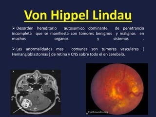 Von Hippel Lindau
 Desorden hereditario autosomico dominante de penetrancia
incompleta que se manifiesta con tomores benignos y malignos en
muchos organos y sistemas .
 Las anormalidades mas comunes son tumores vasculares (
Hemangioblastomas ) de retina y CNS sobre todo el en cerebelo.
 