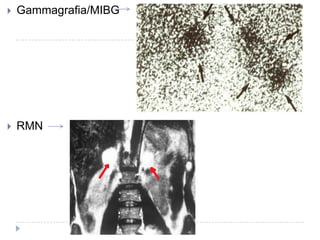 

Gammagrafia/MIBG



RMN

 