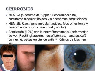 SÍNDROMES




NEM 2A (síndrome de Sipple): Feocromocitoma,
carcinoma medular tiroideo y a adenomas paratiroideos.
NEM 2B: Carcinoma medular tiroideo, feocromocitoma y
neuromas de las mucosas (oral y ocular).
Asociación (10%) con la neurofibromatosis I(enfermedad
de Von Recklinghausen): neurofibromas, manchas café
con leche, pecas en piel de axila y nódulos de Lisch en
iris.

 