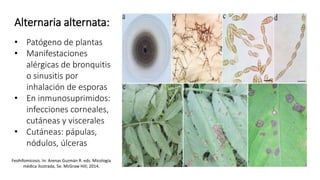 Alternaria alternata:
• Patógeno de plantas
• Manifestaciones
alérgicas de bronquitis
o sinusitis por
inhalación de esporas
• En inmunosuprimidos:
infecciones corneales,
cutáneas y viscerales
• Cutáneas: pápulas,
nódulos, úlceras
Feohifomicosis. In: Arenas Guzmán R. eds. Micología
médica ilustrada, 5e. McGraw Hill; 2014.
 