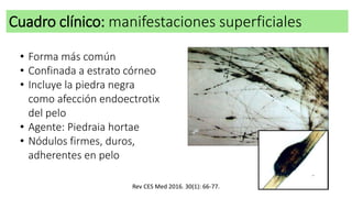 Cuadro clínico: manifestaciones superficiales
• Forma más común
• Confinada a estrato córneo
• Incluye la piedra negra
como afección endoectrotix
del pelo
• Agente: Piedraia hortae
• Nódulos firmes, duros,
adherentes en pelo
Rev CES Med 2016. 30(1): 66-77.
 