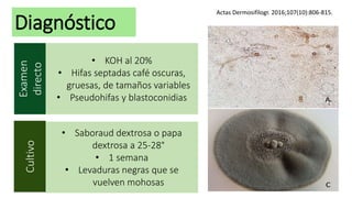Diagnóstico
Examen
directo
Cultivo
• KOH al 20%
• Hifas septadas café oscuras,
gruesas, de tamaños variables
• Pseudohifas y blastoconidias
• Saboraud dextrosa o papa
dextrosa a 25-28°
• 1 semana
• Levaduras negras que se
vuelven mohosas
Actas Dermosifilogr. 2016;107(10):806-815.
 