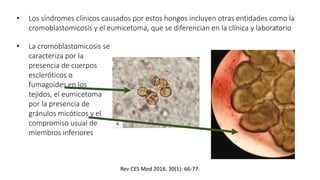 • Los síndromes clínicos causados por estos hongos incluyen otras entidades como la
cromoblastomicosis y el eumicetoma, que se diferencian en la clínica y laboratorio
• La cromoblastomicosis se
caracteriza por la
presencia de cuerpos
escleróticos o
fumagoides en los
tejidos, el eumicetoma
por la presencia de
gránulos micóticos y el
compromiso usual de
miembros inferiores
Rev CES Med 2016. 30(1): 66-77.
 