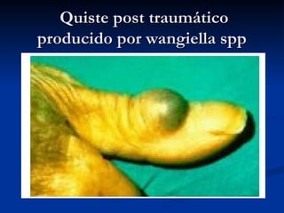 Quiste post traumático
Quiste post traumático
producido por wangiella spp
producido por wangiella spp
 