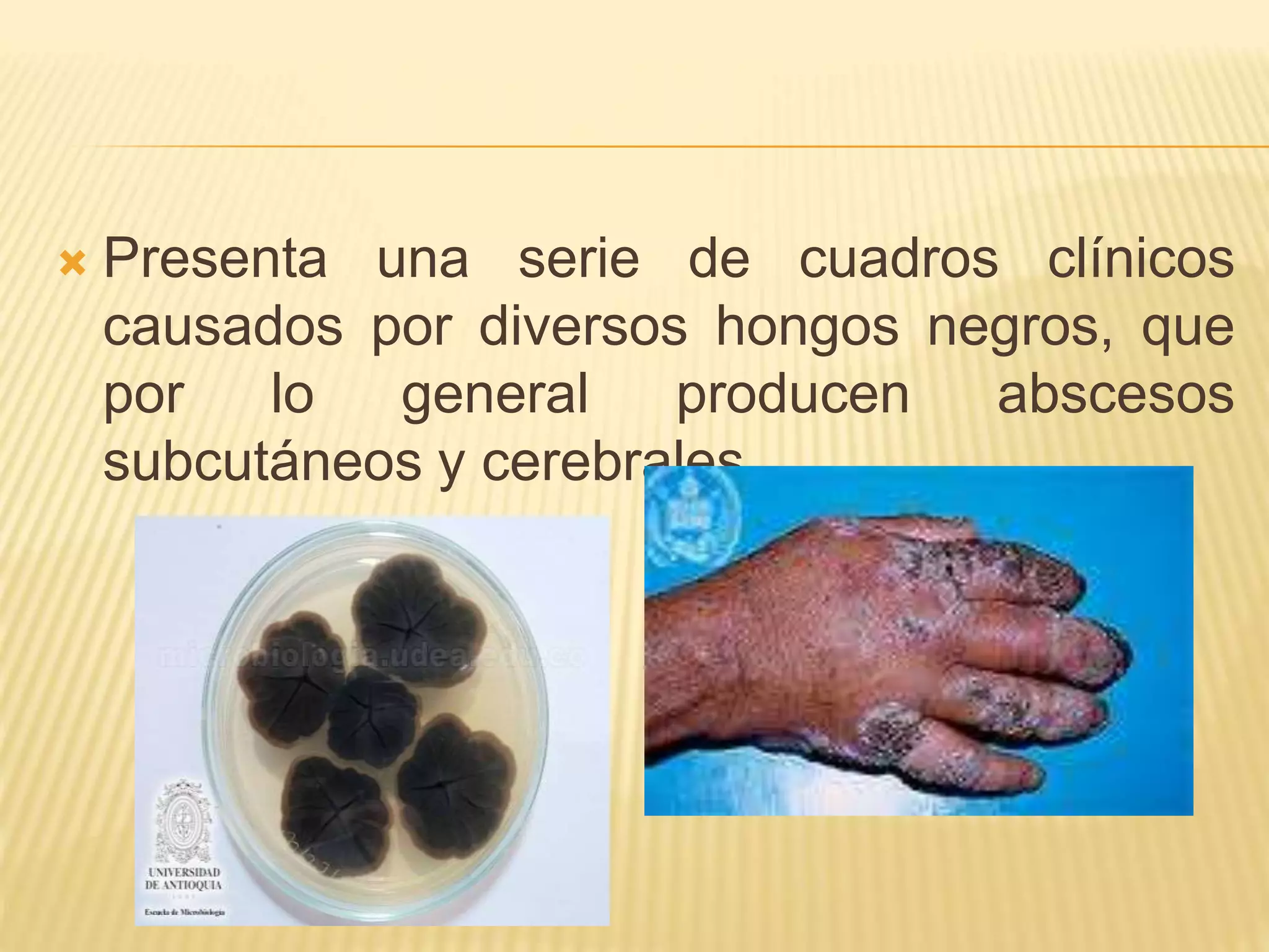 Presenta una serie de cuadros clínicos
causados por diversos hongos negros, que
por lo general producen abscesos
subcutáneos y cerebrales
 
