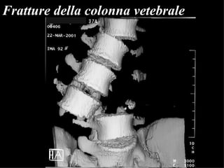Fratture della colonna vetebrale 
