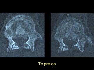 Tc pre op 