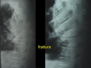 frattura 