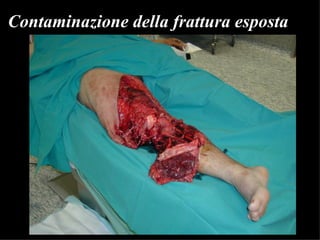Contaminazione della frattura esposta 