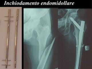 Inchiodamento endomidollare 