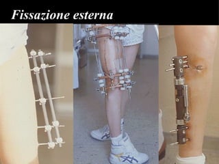 Fissazione esterna 