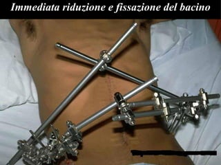 Immediata riduzione e fissazione del bacino 