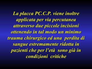 La placca PC.C.P. viene inoltre applicata per via percutanea attraverso due piccole incisioni ottenendo in tal modo un minimo trauma chirurgico ed una  perdita di sangue estremamente ridotta in pazienti che per l’età  sono già in condizioni  critiche 