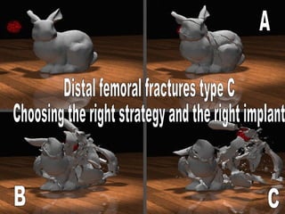 A B C Distal femoral fractures type C Choosing the right strategy and the right implant 