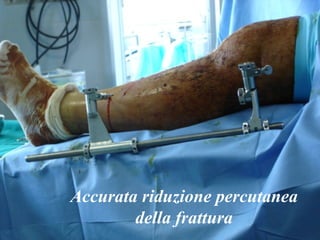 Accurata riduzione percutanea della frattura 