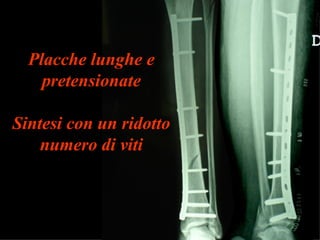 Placche lunghe e pretensionate Sintesi con un ridotto numero di viti 