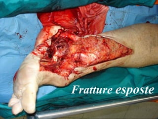 Fratture  esposte 