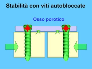 Osso porotico Stabilità con viti autobloccate 