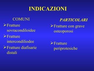 INDICAZIONI COMUNI Fratture sovracondiloidee Fratture intercondiliodee Fratture diafisarie distali PARTICOLARI Fratture con grave osteoporosi Fratture periprotesiche 