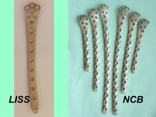 LISS  NCB 