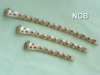 NCB 