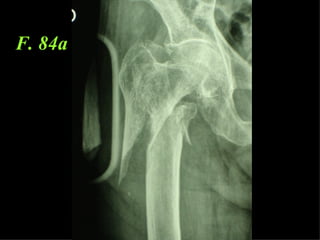 F. 84a 